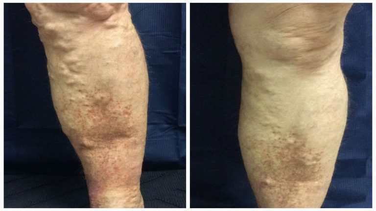 Advanced Varicose Veins Treatment In San Jose For Lasting Relief
