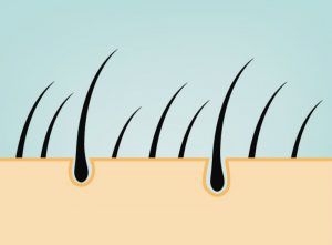 Laser Hair Removal in Philadelphia and Other Dermatology Procedures