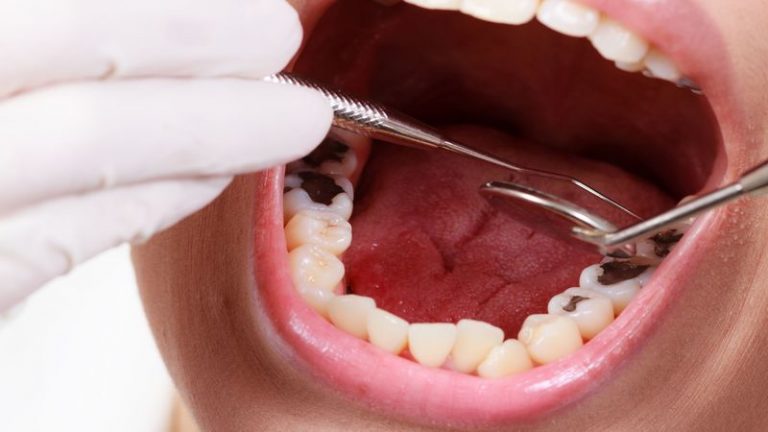 Dental Crowns in Westlake, OH: Precision in Dental Restoration