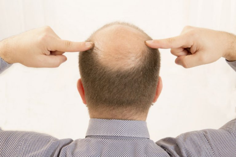 Essential Benefits of Choosing a Quality Hair Transplant Clinic in Connecticut