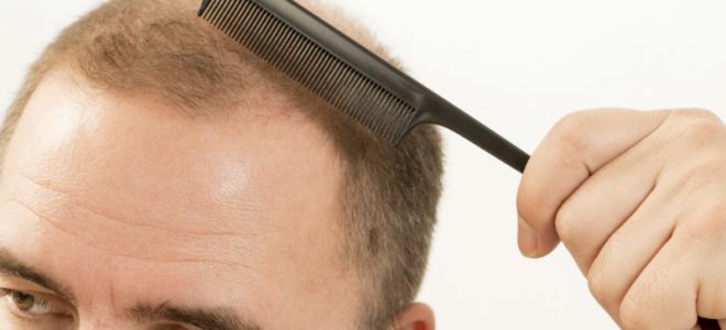3 Benefits of a Hair Transplant For Men in Fort Lauderdale, FL