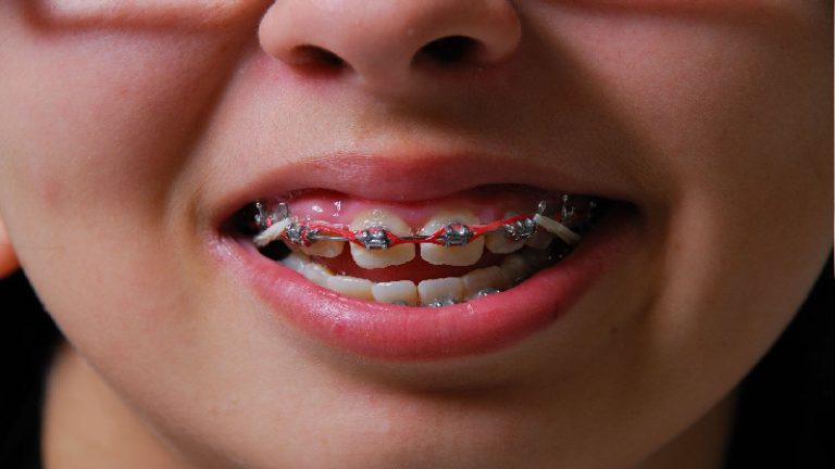Looking For Braces For Adults In Medina, OH? Here’s What You Need To Know