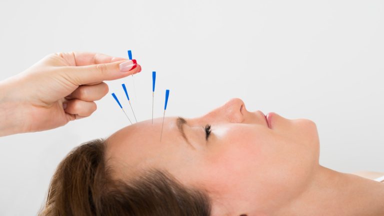 Achieve Inner Peace With Acupuncture For Stress In Berkeley, CA