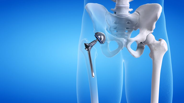 Enhance Mobility with a Custom Medical Brace Kafo That Fits Your Lifestyle