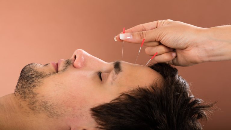 Chronic Pain Relief Is Within Reach With Acupuncture Bellingham WA Solutions