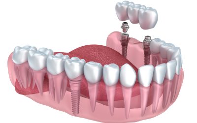 Choosing the Right Braces Jackson MS Patients Trust for Straighter Smiles and Lasting Confidence