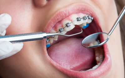 Orthodontic Services Louisville, KY: Solutions to Common Teeth Alignment Concerns
